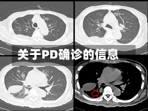 关于PD确诊的信息