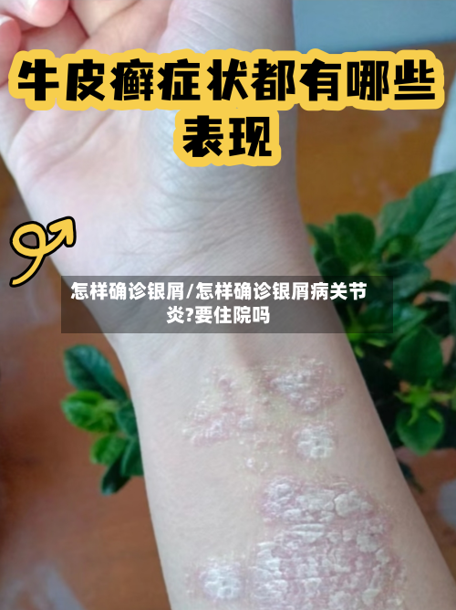 怎样确诊银屑/怎样确诊银屑病关节炎?要住院吗-第3张图片